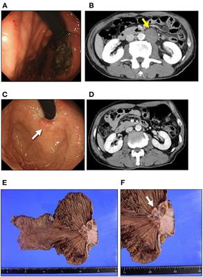 Case Report: A Rare Case of Esophagogastric Junctional Squamous Cell Carcinoma After the Successful Treatment of Neuroendocrine Carcinoma: Clonal Tumor Evolution Revealed by Genetic Analysis